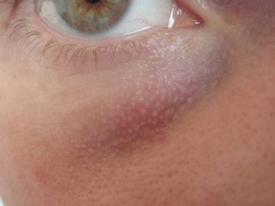 มีตุ่มเล็กๆสีขาวเหลืองหลายๆตุ่มที่เปลือกตาล่างคืออะไร : เป็นต่อมไขมันที่เด่นชัดครับ Prominent sebaceous gland ครับ มีตุ่มเล็กๆสีขาวเหลืองหลายๆตุ่มที่เปลือกตาล่างคืออะไร : เป็นต่อมไขมันที่เด่นชัดครับ Prominent sebaceous gland ครับ