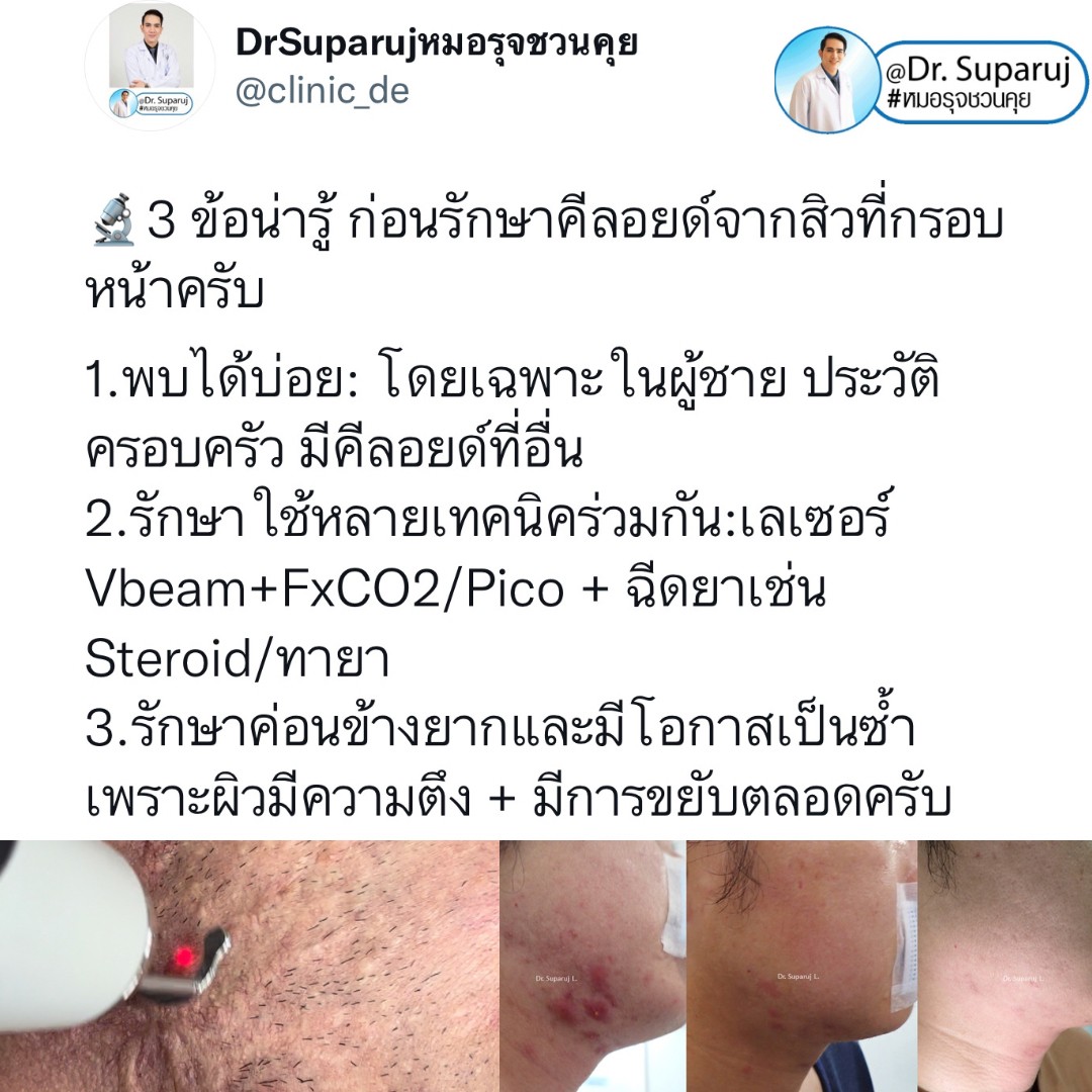 มีปัญหาหลุมสิว แต่ยังมีสิวขึ้นอยู่ สามารถรักษาหลุมสิวได้เลยไหม หรือควรดูแลอย่างไร?