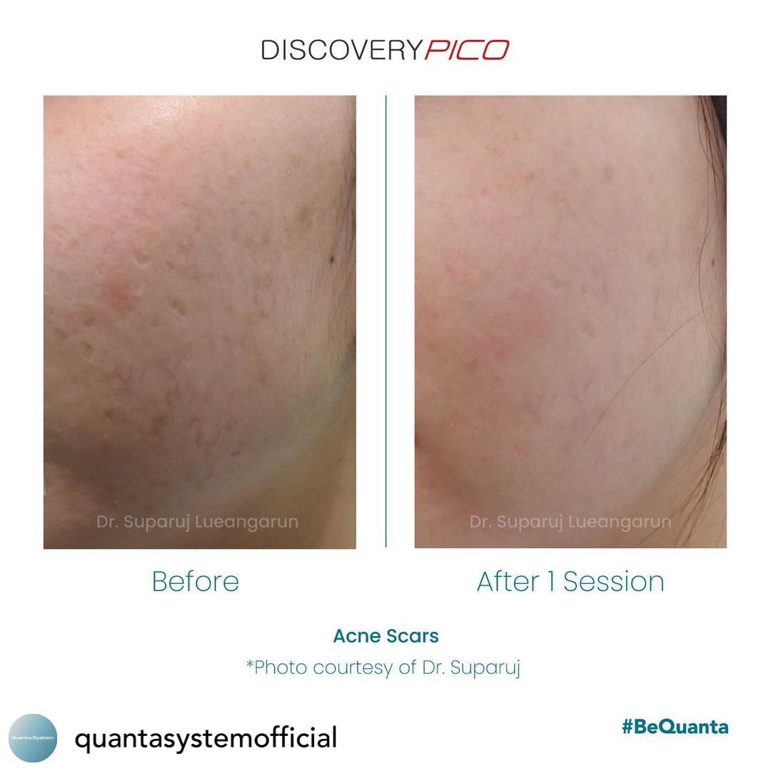 Update Discovery Picosecond Laser จุดเด่น & หลักการทำงาน ใช้ดูแลหลุมสิว แผลเป็น รอยแตกลาย ฝ้า กระจุดด่างดำ ได้อย่างไร ?  Update Discovery Picosecond Laser จุดเด่น & หลักการทำงาน ใช้ดูแลหลุมสิว แผลเป็น รอยแตกลาย ฝ้า กระจุดด่างดำ ได้อย่างไร ?