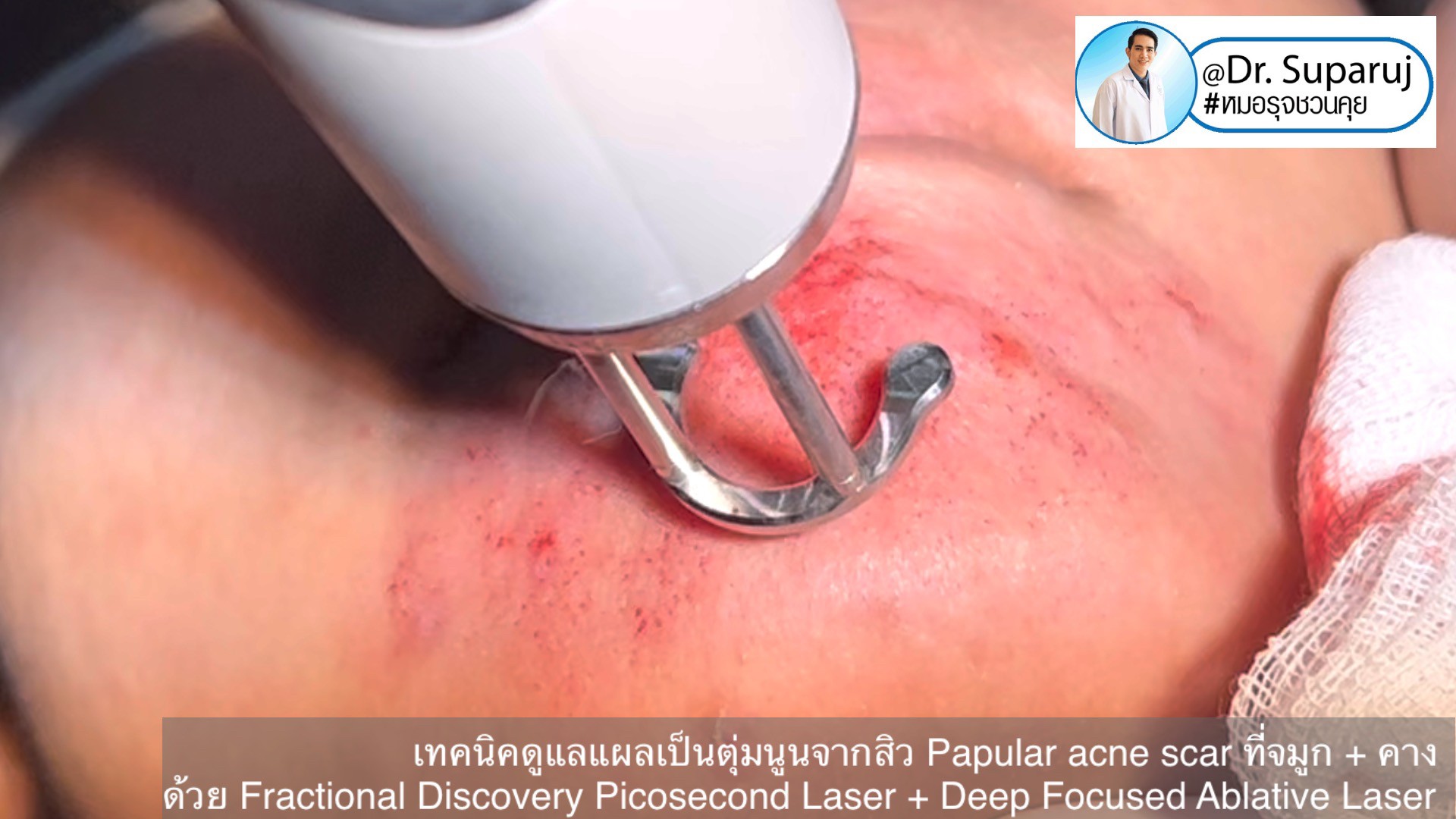 เทคนิคดูแลแผลเป็นตุ่มนูนจากสิว Papular acne scar ที่จมูก + คาง ด้วย Fractional Discovery Picosecond Laser + Deep Focused Ablative Laser เทคนิคดูแลแผลเป็นตุ่มนูนจากสิว Papular acne scar ที่จมูก + คาง ด้วย Fractional Discovery Picosecond Laser + Deep Focused Ablative Laser