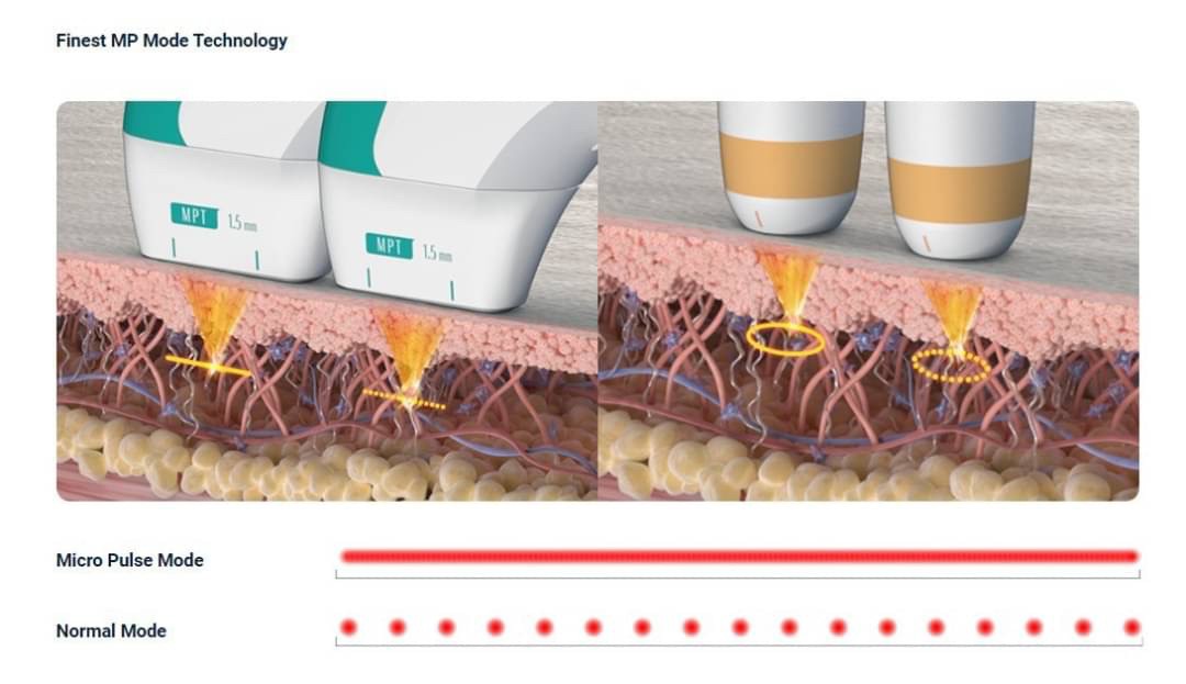แนะนำนวัตกรรม Ultraformer MPT UltraBooster Pen-type Circular Headpiece สำหรับงานผิว (Ultraformer MPT Ultraboost Mode for Skin Tighthening & Brightening)  แนะนำนวัตกรรม Ultraformer MPT UltraBooster Pen-type Circular Headpiece สำหรับงานผิว (Ultraformer MPT Ultraboost Mode for Skin Tighthening & Brightening)