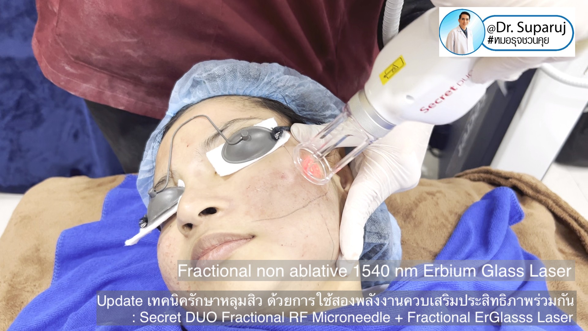 Update เทคนิครักษาหลุมสิว ด้วยการใช้สองพลังงานเสริมประสิทธิภาพร่วมกัน: Secret DUO Fractional RF Microneedle + Fractional ErGlasss Laser