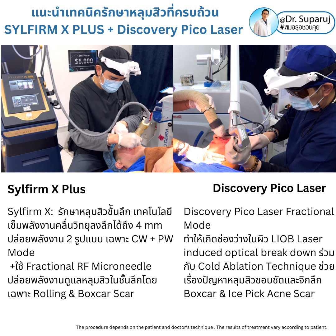 แนะนำเทคนิคดูแลรักษาหลุมสิว: เทคนิครักษาหลุมสิวด้วย 2 เทคนิคเสริมประสิทธิภาพ SYLFIRM X Plus + Discovery Pico Laser Combination Treatment