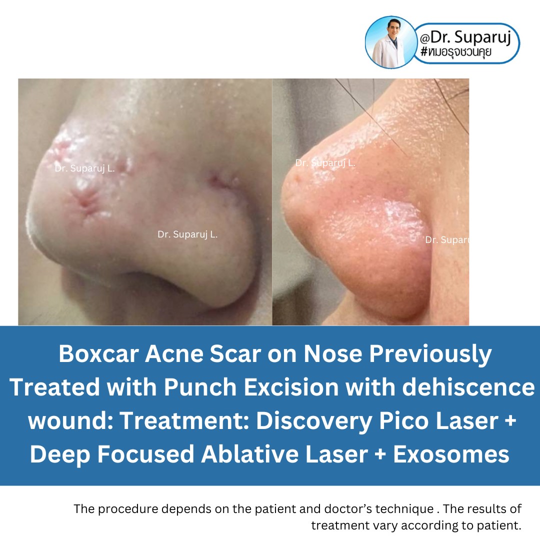 แนะนำเทคนิคดูแลรักษาหลุมสิว: เทคนิครักษาหลุมสิวด้วย 2 เทคนิคเสริมประสิทธิภาพ SYLFIRM X Plus + Discovery Pico Laser Combination Treatment แนะนำเทคนิคดูแลรักษาหลุมสิว: เทคนิครักษาหลุมสิวด้วย 2 เทคนิคเสริมประสิทธิภาพ SYLFIRM X Plus + Discovery Pico Laser Combination Treatment