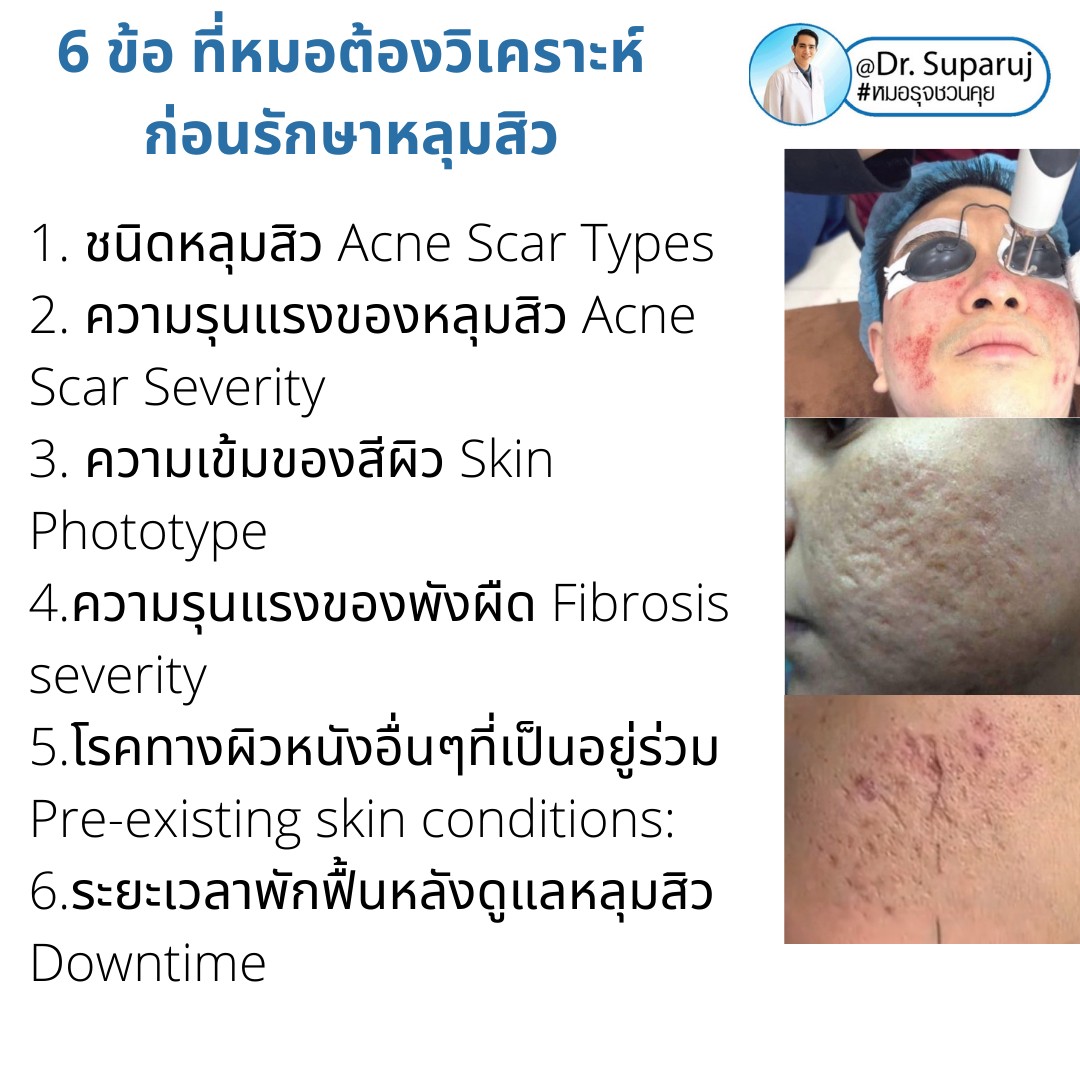 แนะนำเทคนิคดูแลหลุมสิว: เทคนิคการรักษาหลุมสิวชนิดไหนดีที่สุด? แนะนำเทคนิคดูแลหลุมสิว: เทคนิคการรักษาหลุมสิวชนิดไหนดีที่สุด?