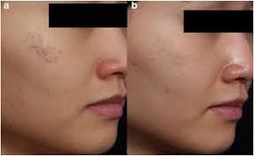 เทคนิครักษากระโฮริ กระลึก ปานโฮริ (Hori's nevus) ด้วยเลเซอร์ Discovery Picosecond Laser เทคนิครักษากระโฮริ กระลึก ปานโฮริ (Hori's nevus) ด้วยเลเซอร์ Discovery Picosecond Laser