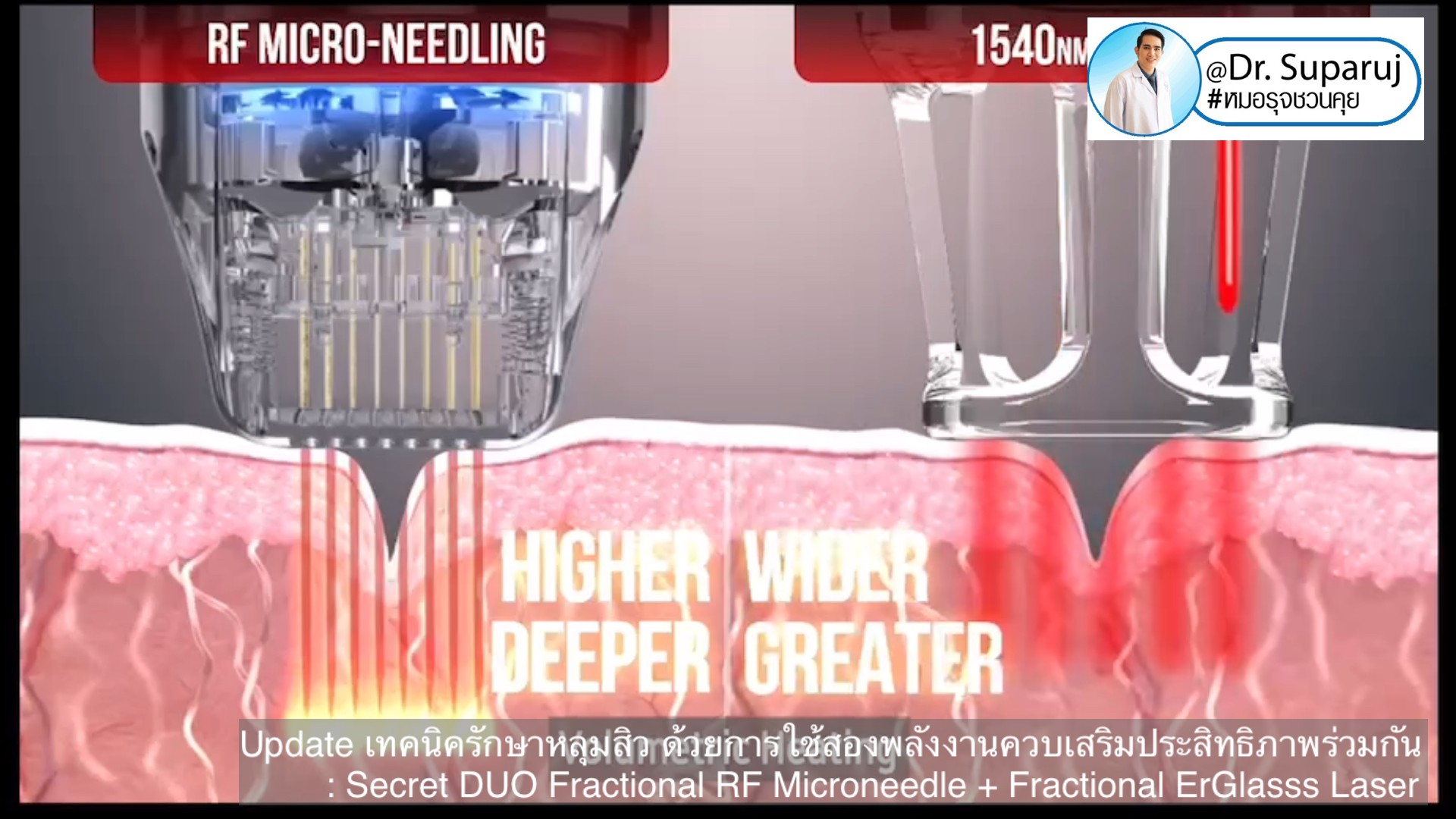 Update เทคนิครักษาหลุมสิว ด้วยการใช้สองพลังงานเสริมประสิทธิภาพร่วมกัน: Secret DUO Fractional RF Microneedle + Fractional ErGlasss Laser Update เทคนิครักษาหลุมสิว ด้วยการใช้สองพลังงานเสริมประสิทธิภาพร่วมกัน: Secret DUO Fractional RF Microneedle + Fractional ErGlasss Laser