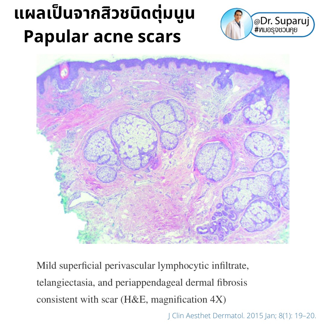 เทคนิคดูแลแผลเป็นตุ่มนูนจากสิว Papular acne scar ที่จมูก + คาง ด้วย Fractional Discovery Picosecond Laser + Deep Focused Ablative Laser เทคนิคดูแลแผลเป็นตุ่มนูนจากสิว Papular acne scar ที่จมูก + คาง ด้วย Fractional Discovery Picosecond Laser + Deep Focused Ablative Laser