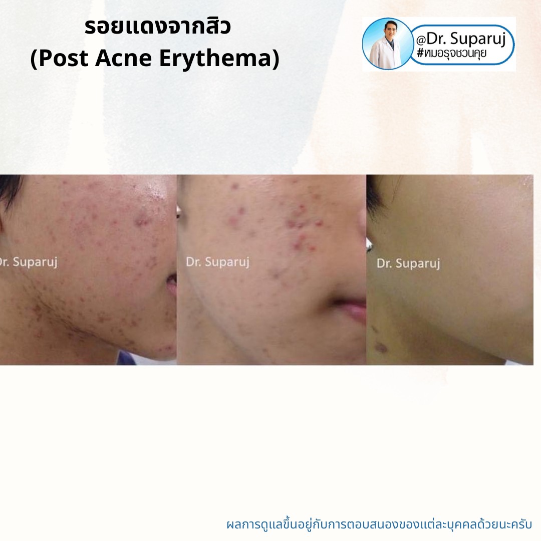 แชร์ประสบการณ์ Discovery Pico Laser พลีชีพความจริง แชร์ประสบการณ์ Discovery Pico Laser พลีชีพความจริง