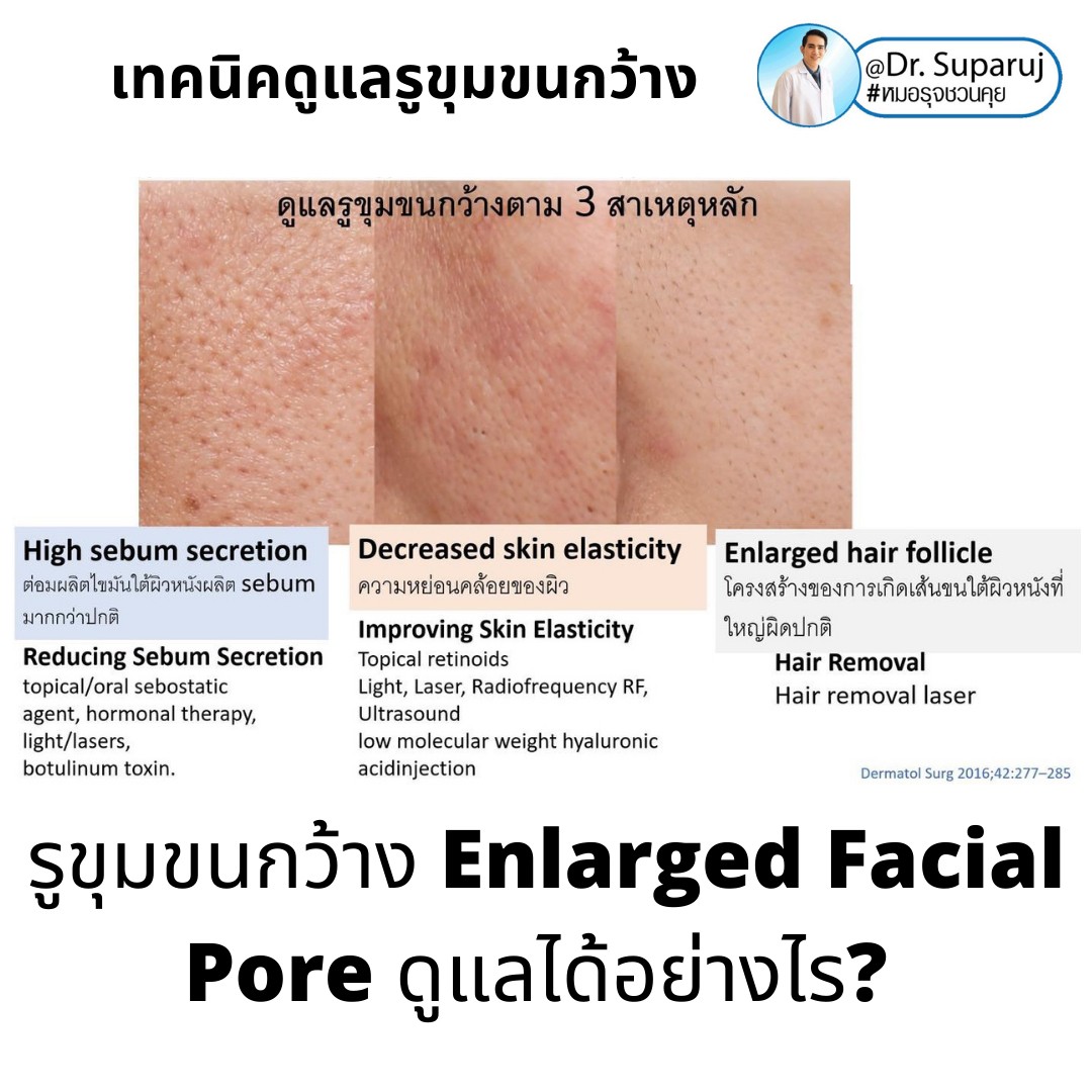 เทคนิควิเคราะห์ & รักษาขุมขนกว้าง Enlarged Facial Pore ด้วยกล้อส่องขยายพิเศษทางผิวหนัง Dermoscopy