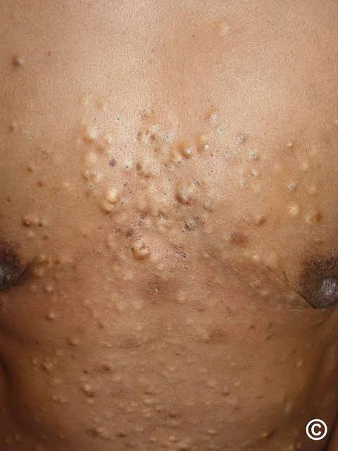 แนะนำเทคนิคดูแล ก้อนซีสต์จากท่อต่อมไขมัน Steatocystoma Multiplex (SM) ด้วย เข็มพลังงานคลื่นวิทยุ Insulated Radiofrequency RF Microneedle for Steatocystoma Multiplex Treatment แนะนำเทคนิคดูแล ก้อนซีสต์จากท่อต่อมไขมัน Steatocystoma Multiplex (SM) ด้วย เข็มพลังงานคลื่นวิทยุ Insulated Radiofrequency RF Microneedle for Steatocystoma Multiplex Treatment