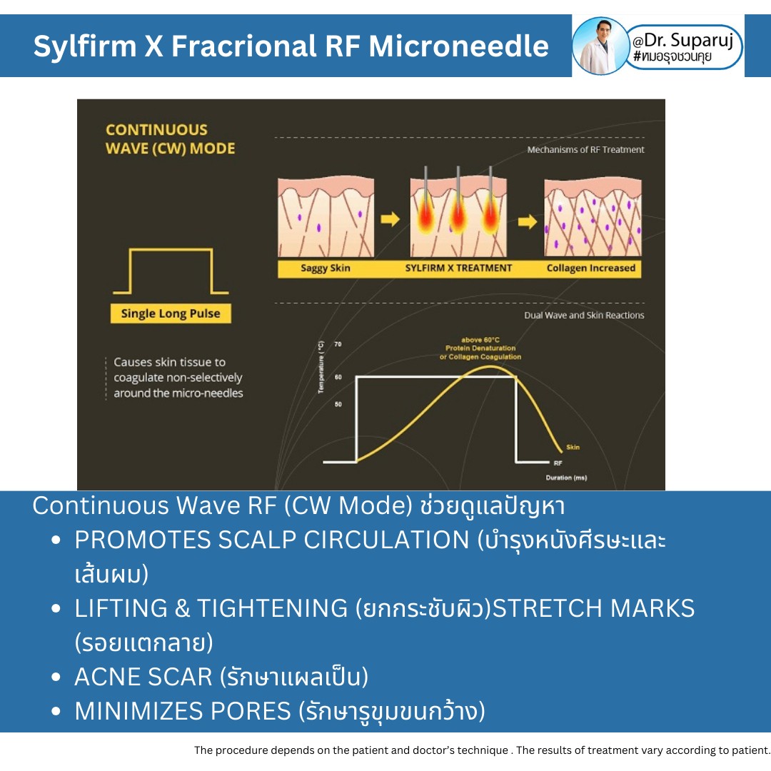 Update เทคนิคยกกระชับผิว หลุมสิว ดูแลปัญหาเม็ดสี ฝ้า+เส้นเลือด ด้วยนวัตกรรมคลื่นวิทยุแบบเข็ม Fractional microneedle Radiofrequency : SYLFIRM X