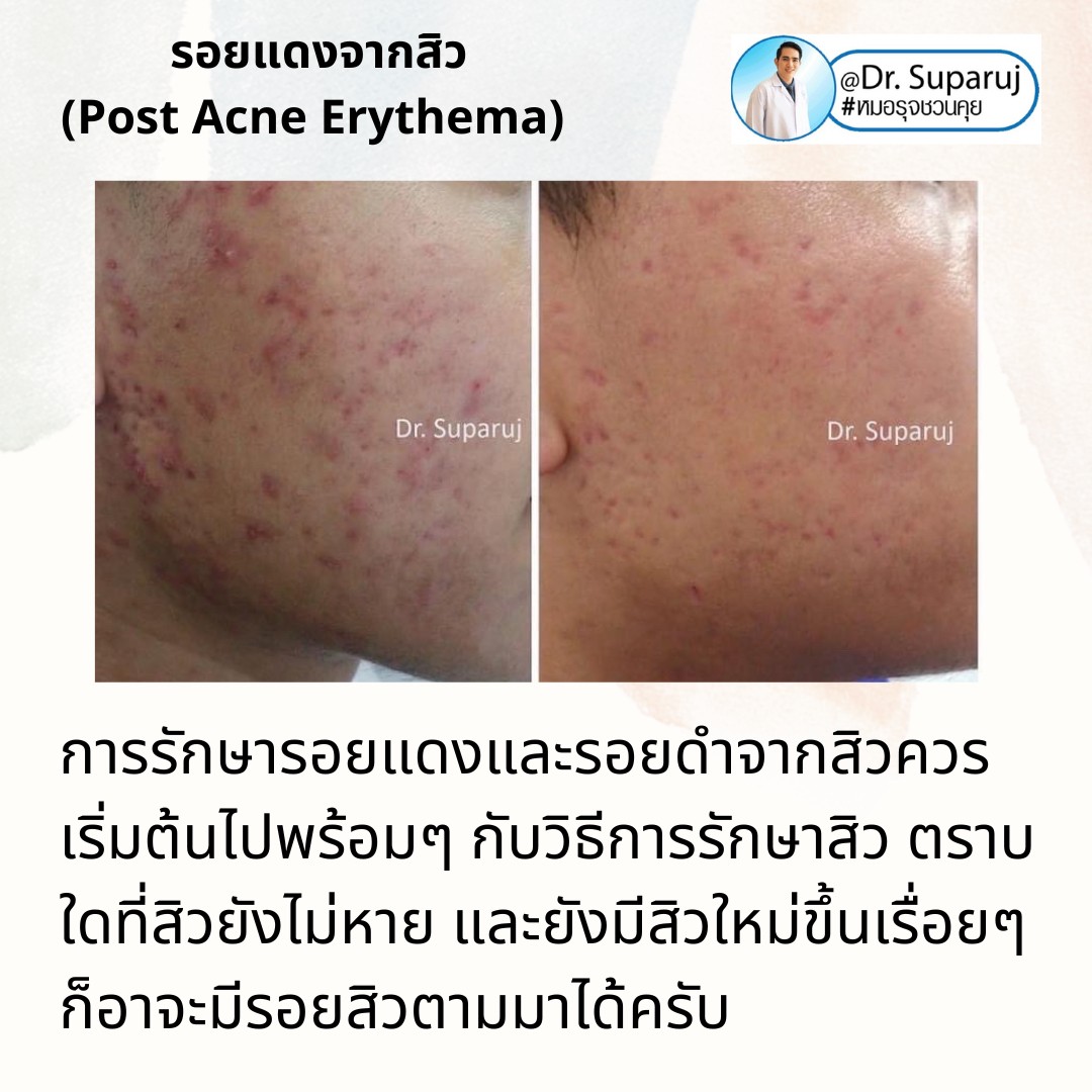 แชร์ประสบการณ์ Discovery Pico Laser พลีชีพความจริง