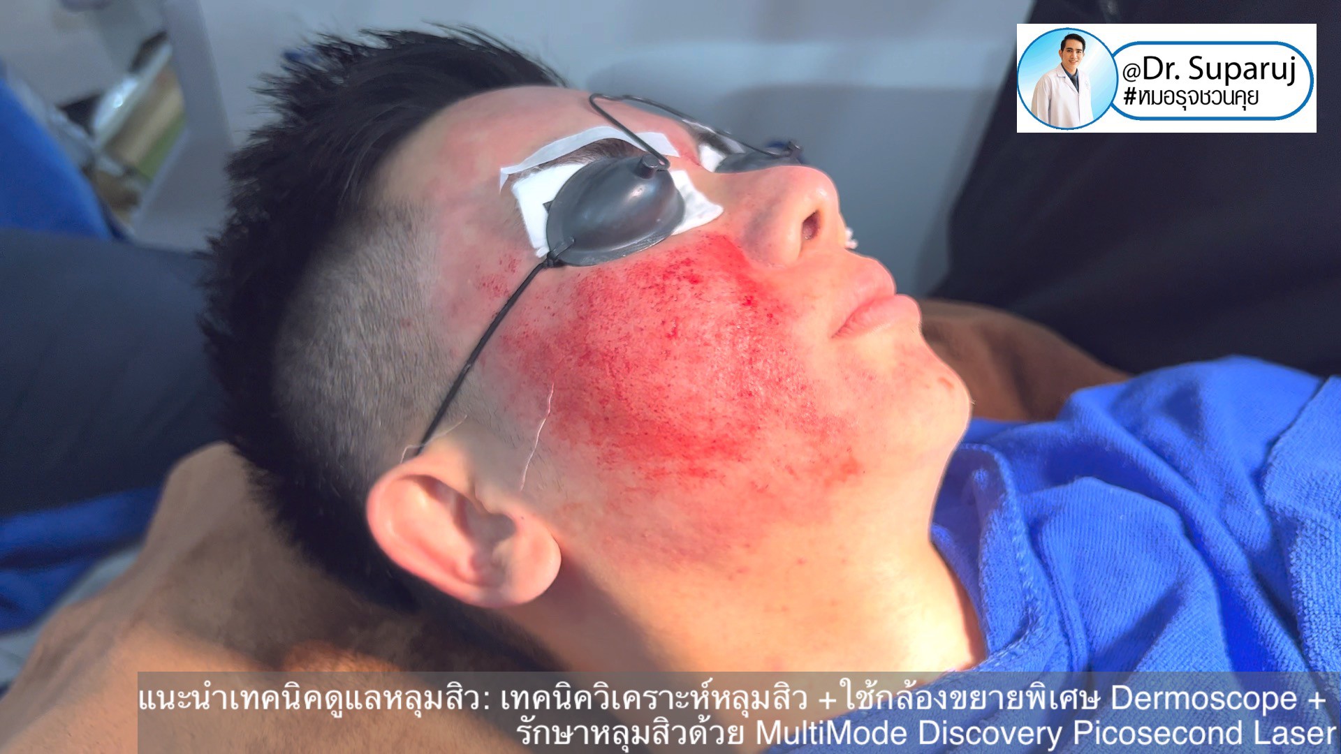 แนะนำเทคนิคดูแลหลุมสิว: เทคนิควิเคราะห์หลุมสิว +ใช้กล้องขยายพิเศษ Dermoscope + รักษาหลุมสิวด้วย MultiMode Discovery Picosecond Laser + Exosome Therapy แนะนำเทคนิคดูแลหลุมสิว: เทคนิควิเคราะห์หลุมสิว +ใช้กล้องขยายพิเศษ Dermoscope + รักษาหลุมสิวด้วย MultiMode Discovery Picosecond Laser + Exosome Therapy