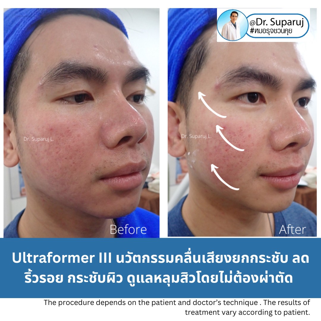 เทคโนโลยียกกระชับผิว MMFU : Micro &Macro Focused Ultrasound ของ Ultraformer III ทำงานอย่างไร ทำไมถึงดีกว่า HIFU ?