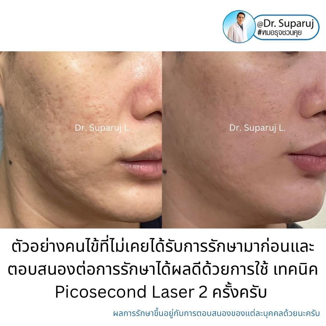 มีสิวอักเสบเม็ดใหญ่ ไม่มีหัว ขึ้น ดูแลอย่างไรดี ? มีสิวอักเสบเม็ดใหญ่ ไม่มีหัว ขึ้น ดูแลอย่างไรดี ?