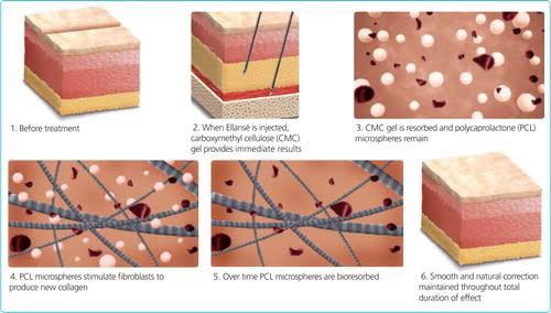 Update เทคนิคกระตุ้นการสร้างคอลลาเจนในผิวหนังลดเลือนริ้วรอย: Collagen Biostimulator Update เทคนิคกระตุ้นการสร้างคอลลาเจนในผิวหนังลดเลือนริ้วรอย: Collagen Biostimulator