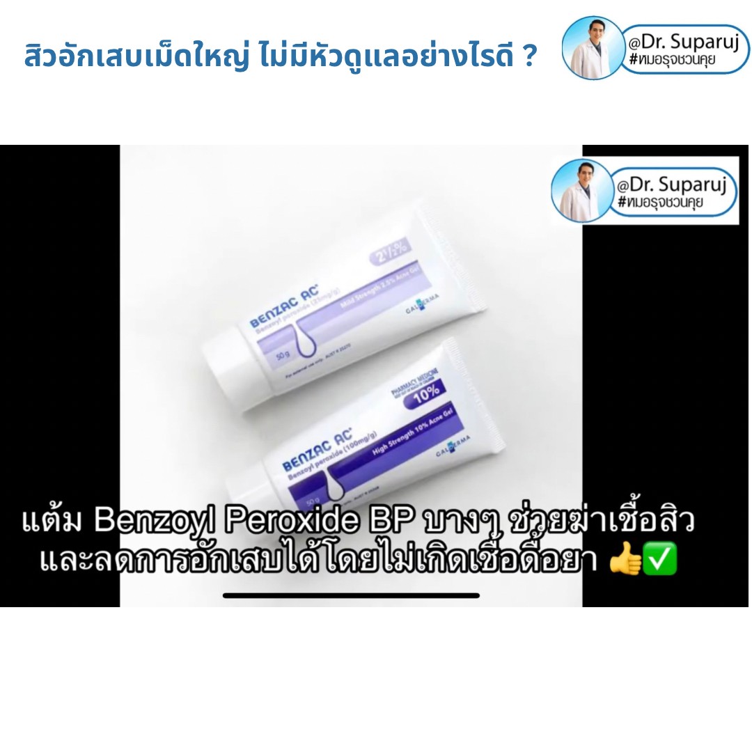 มีสิวอักเสบเม็ดใหญ่ ไม่มีหัว ขึ้น ดูแลอย่างไรดี ?