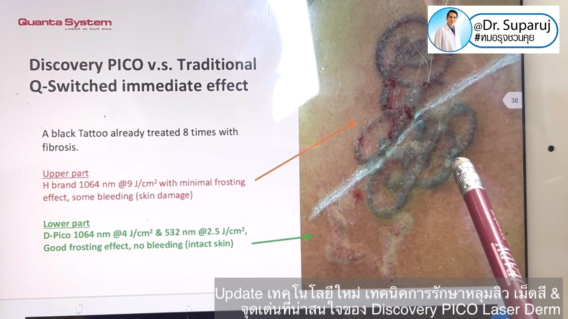 Update เทคโนโลยีใหม่ เทคนิคการรักษาหลุมสิว เม็ดสี & จุดเด่นที่น่าสนใจของ Discovery PICO Laser Derm Update เทคโนโลยีใหม่ เทคนิคการรักษาหลุมสิว เม็ดสี & จุดเด่นที่น่าสนใจของ Discovery PICO Laser Derm