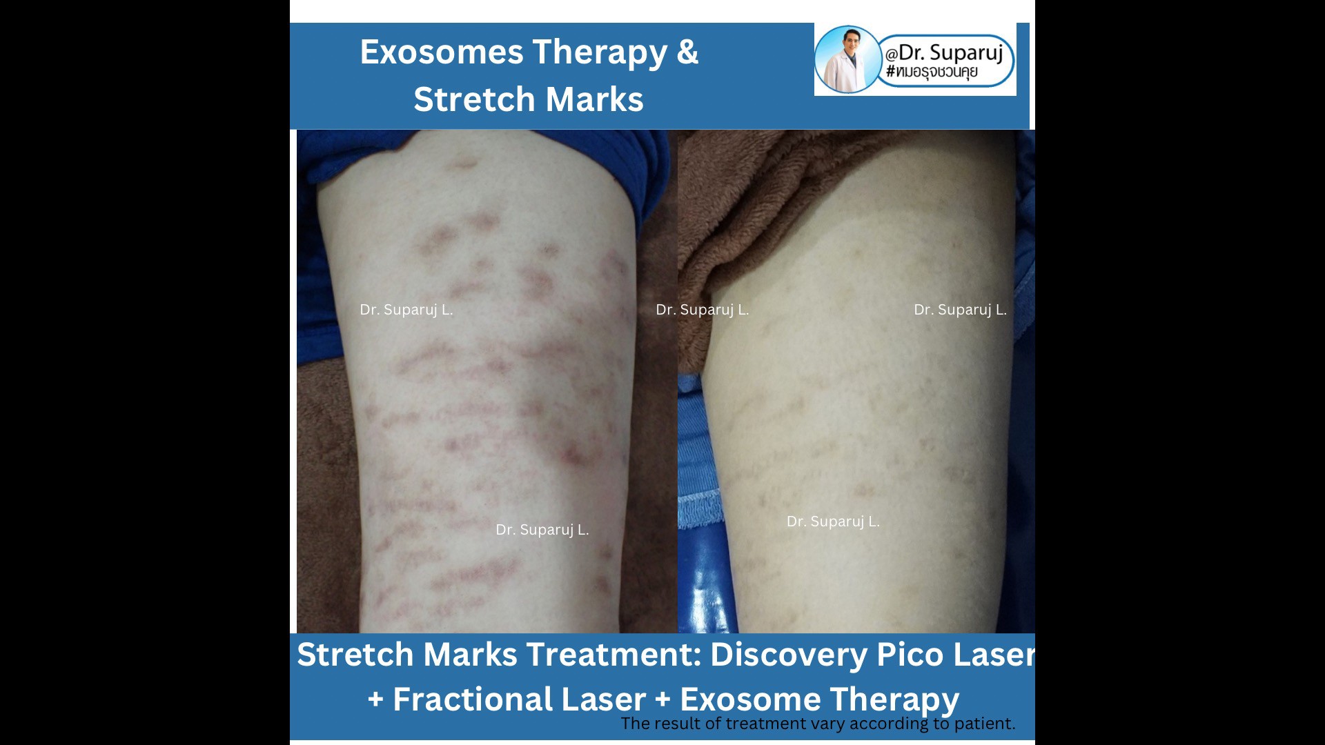 แนะนำเทคนิคดูแลรอยแตกลาย: รักษาผิวแตกลายด้วยเทคนิคเลเซอร์ Discovery Pico Laser + Fractional Ablative Laser + Exosomes