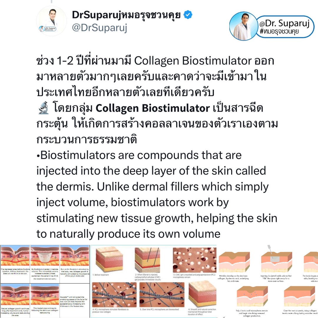 Update เทคนิคกระตุ้นการสร้างคอลลาเจนในผิวหนังลดเลือนริ้วรอย: Collagen Biostimulator