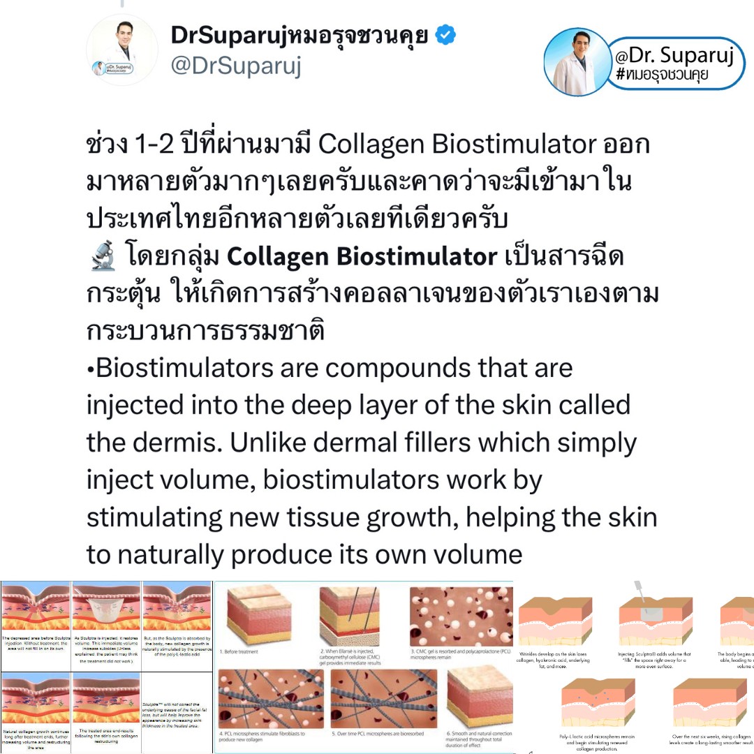 Update เทคนิคกระตุ้นการสร้างคอลลาเจนในผิวหนังลดเลือนริ้วรอย: Collagen Biostimulator Update เทคนิคกระตุ้นการสร้างคอลลาเจนในผิวหนังลดเลือนริ้วรอย: Collagen Biostimulator