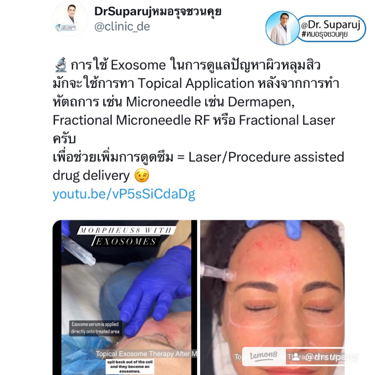 แนะนำเทคนิคดูแลรูขุมขนกว้าง: เทคนิคดูแลรูขุมขนกว้างด้วย Deep Carbon Peel Picosecond Laser (เทคนิคการใช้ Picosecond Laser พิโค่เลเซอร์ ร่วมกับผง carbon กระตุ้นการสร้างคอลลาเจนดูแลรูขุมขนกว้าง ) แนะนำเทคนิคดูแลรูขุมขนกว้าง: เทคนิคดูแลรูขุมขนกว้างด้วย Deep Carbon Peel Picosecond Laser (เทคนิคการใช้ Picosecond Laser พิโค่เลเซอร์ ร่วมกับผง carbon กระตุ้นการสร้างคอลลาเจนดูแลรูขุมขนกว้าง )