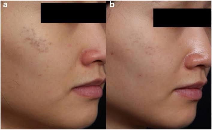 เทคนิครักษากระโฮริ กระลึก ปานโฮริ (Hori's nevus) ด้วยเลเซอร์ Discovery Picosecond Laser เทคนิครักษากระโฮริ กระลึก ปานโฮริ (Hori's nevus) ด้วยเลเซอร์ Discovery Picosecond Laser