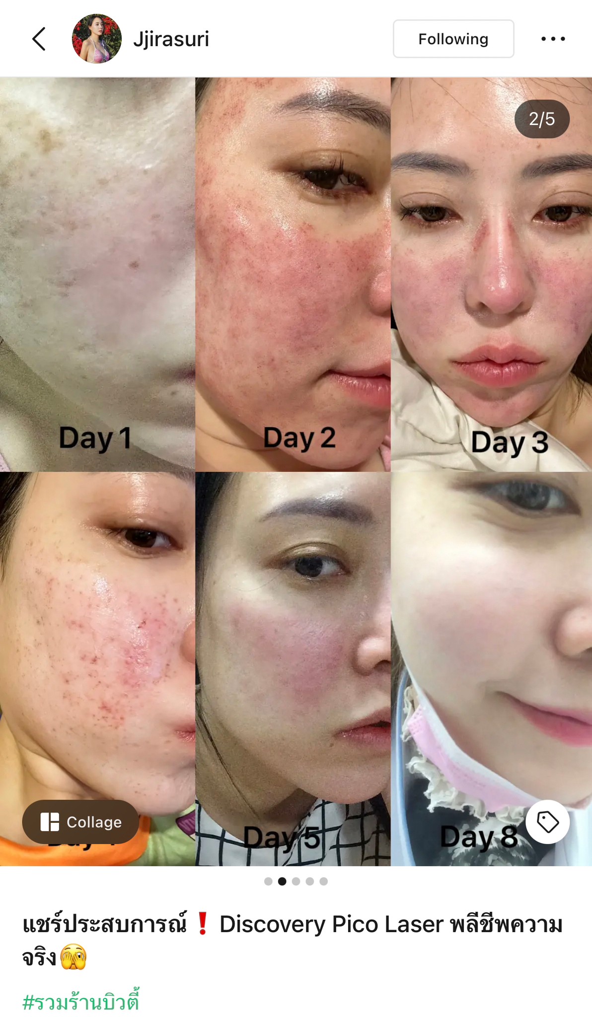 แชร์ประสบการณ์ Discovery Pico Laser พลีชีพความจริง แชร์ประสบการณ์ Discovery Pico Laser พลีชีพความจริง