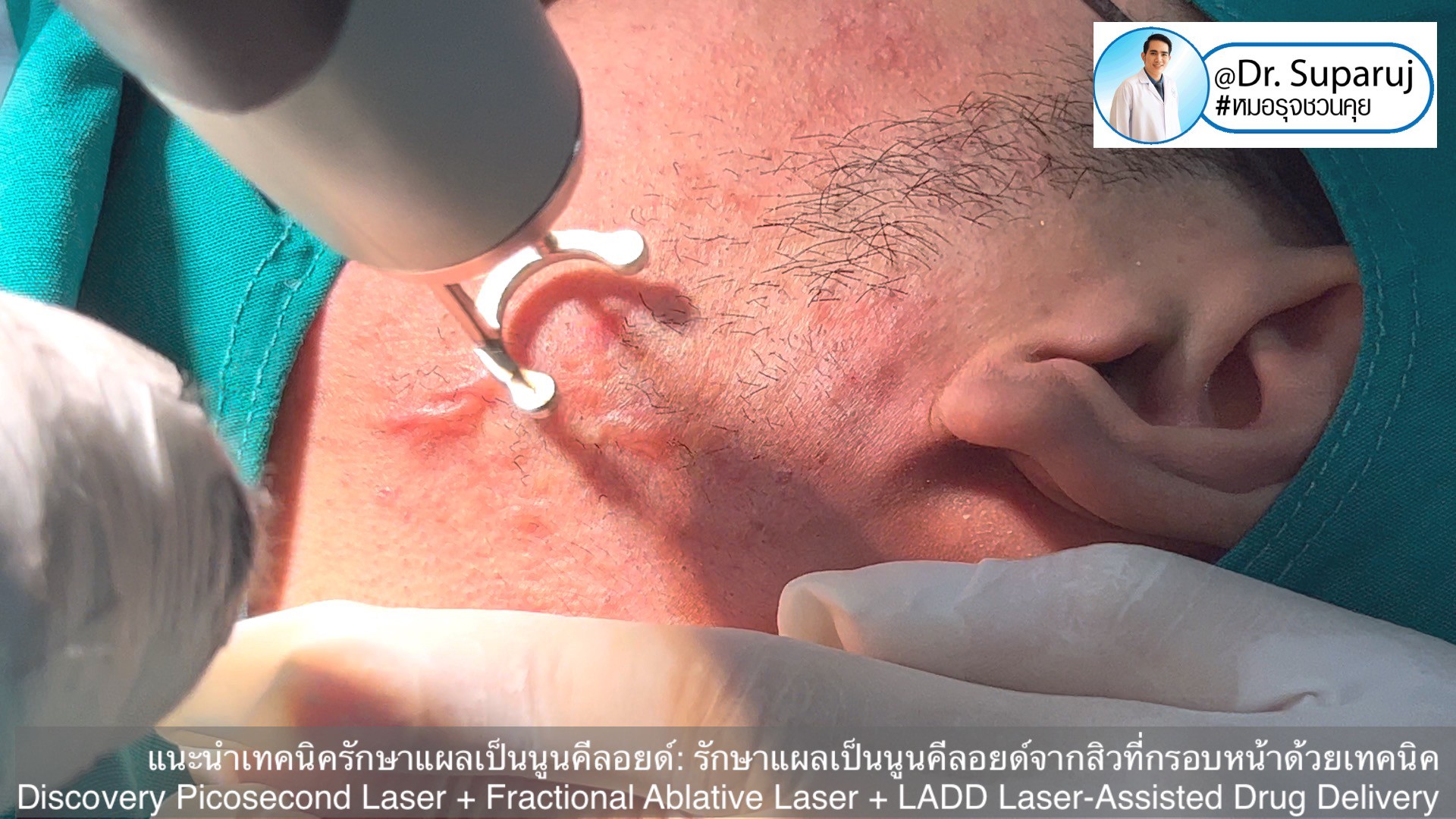 แนะนำเทคนิคดูแลแผลเป็นนูนคีลอยด์: รักษาแผลเป็นนูนคีลอยด์จากสิวที่กรอบหน้าด้วยเทคนิค Discovery Picosecond Laser + Fractional Ablative Laser + LADD Laser-Assisted Drug Delivery แนะนำเทคนิคดูแลแผลเป็นนูนคีลอยด์: รักษาแผลเป็นนูนคีลอยด์จากสิวที่กรอบหน้าด้วยเทคนิค Discovery Picosecond Laser + Fractional Ablative Laser + LADD Laser-Assisted Drug Delivery