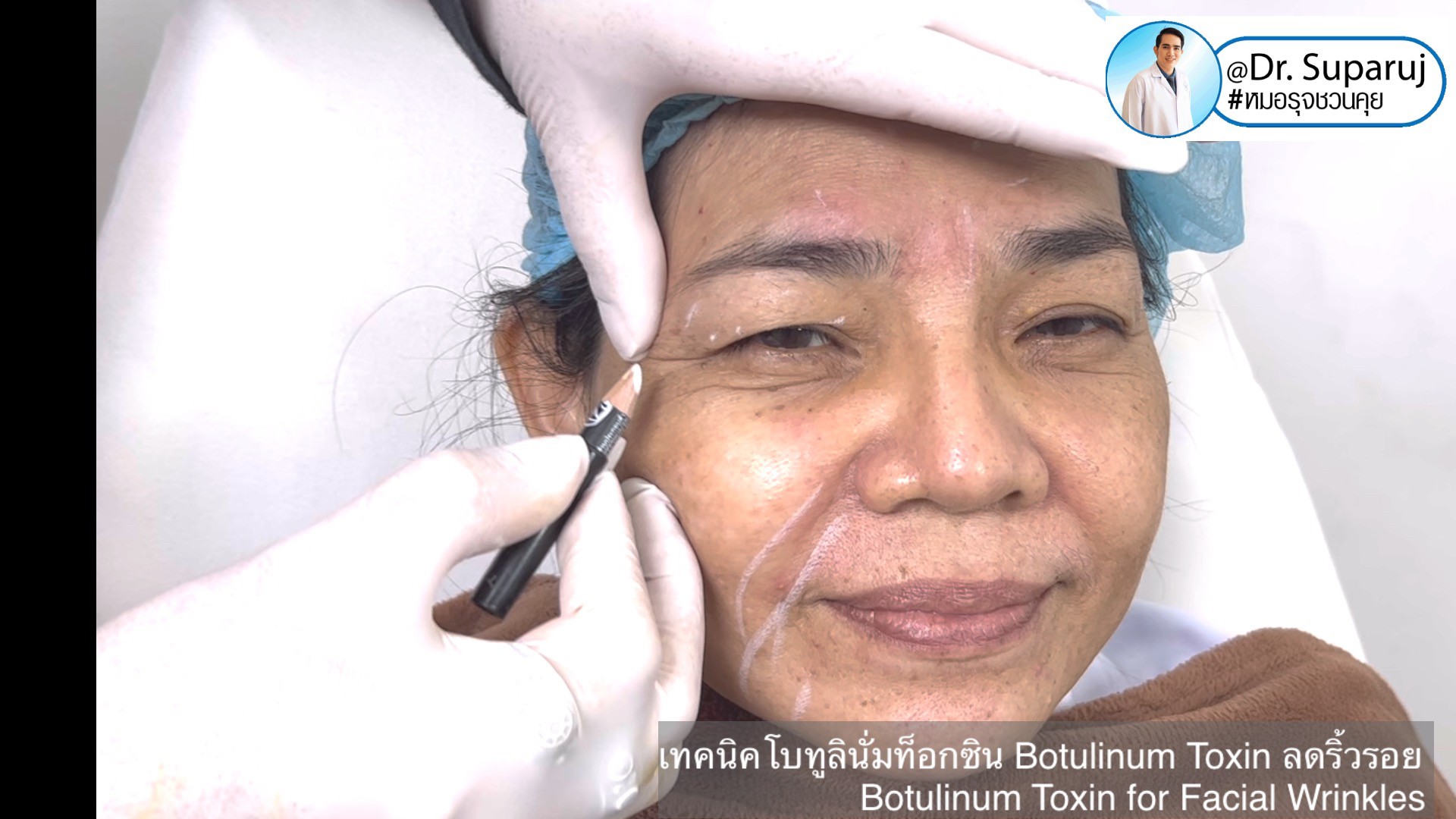 เทคนิคโบทูลินั่มท็อกซิน Botulinum Toxin ลดริ้วรอย Botulinum Toxin for Facial Wrinkles เทคนิคโบทูลินั่มท็อกซิน Botulinum Toxin ลดริ้วรอย Botulinum Toxin for Facial Wrinkles