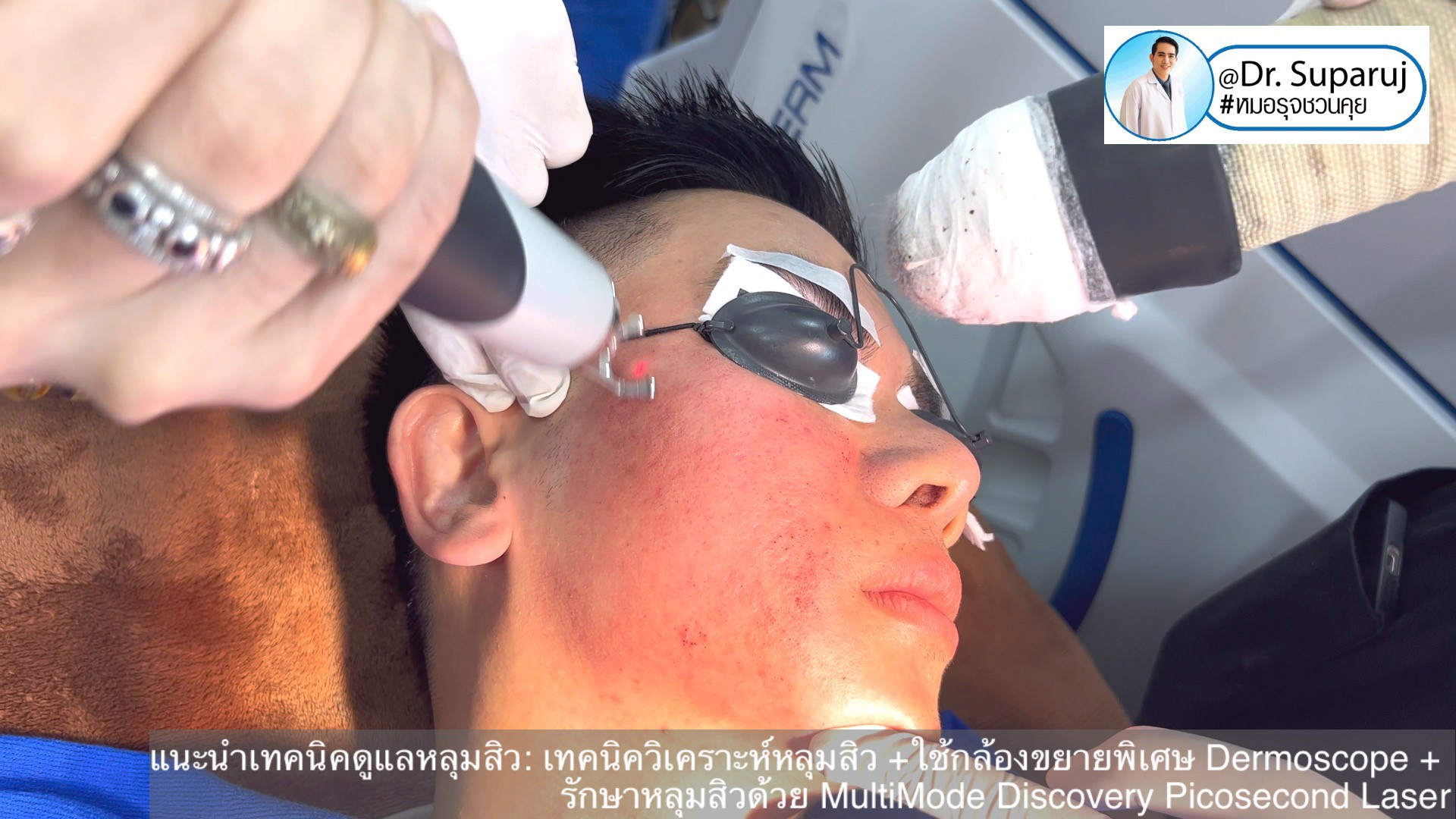 แนะนำเทคนิคดูแลหลุมสิว: เทคนิควิเคราะห์หลุมสิว +ใช้กล้องขยายพิเศษ Dermoscope + รักษาหลุมสิวด้วย MultiMode Discovery Picosecond Laser + Exosome Therapy