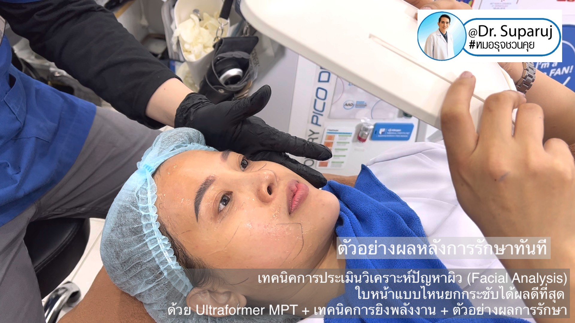  เทคนิคการประเมินวิเคราะห์ปัญหาผิว (Facial Analysis) ใบหน้าแบบไหนยกกระชับได้ผลดีที่สุด ด้วย Ultraformer MPT + เทคนิคการยิงพลังงาน + ตัวอย่างผลการรักษา