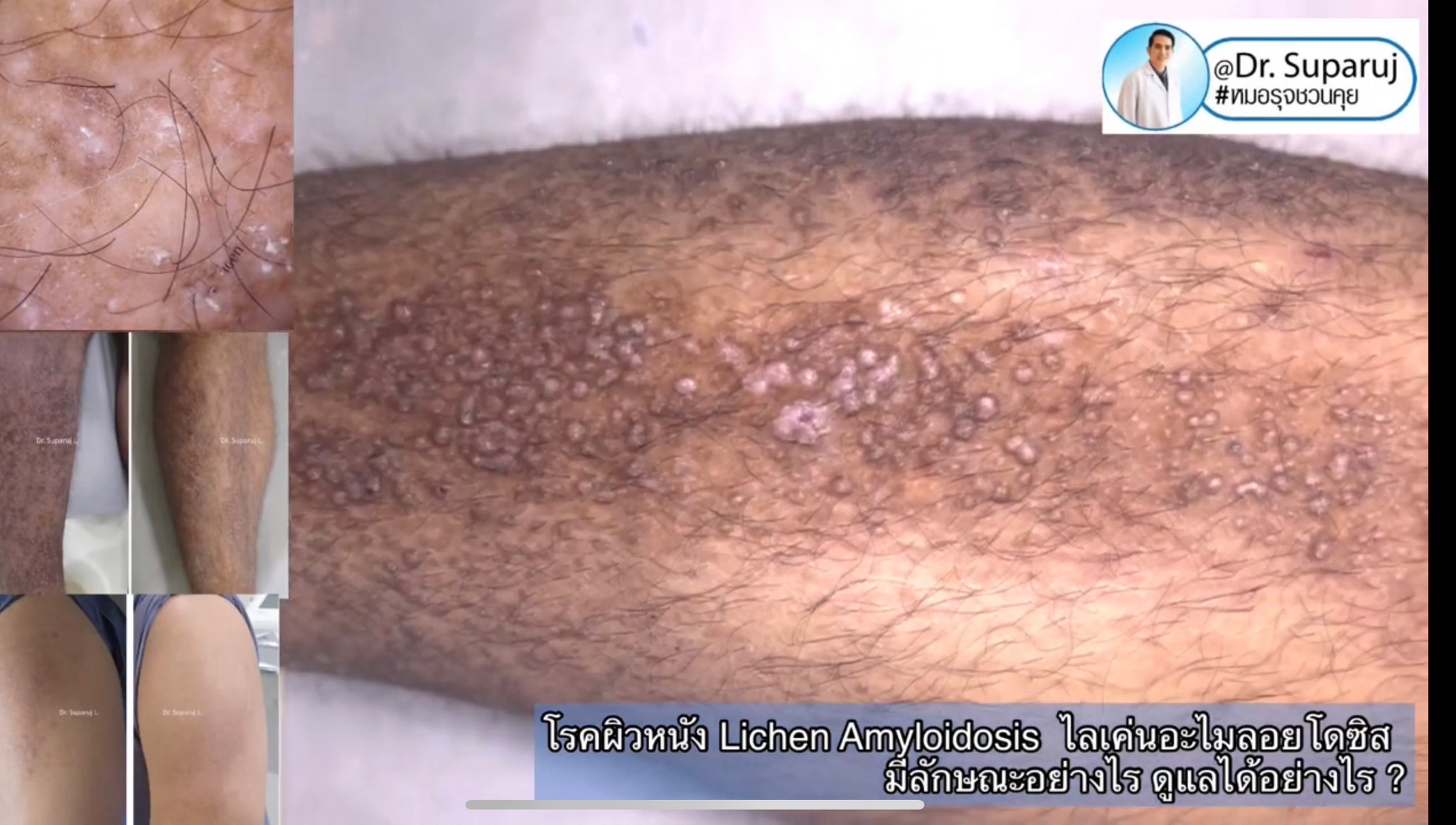 แนะนำการดูแลปัญหาโรคผิวหนัง: โรค Lichen amyloidosis ไลเค่น อะไมลอยโดซิส มีลักษณะอย่างไร ดูแลได้อย่างไร ? แนะนำการดูแลปัญหาโรคผิวหนัง: โรค Lichen amyloidosis ไลเค่น อะไมลอยโดซิส มีลักษณะอย่างไร ดูแลได้อย่างไร ?