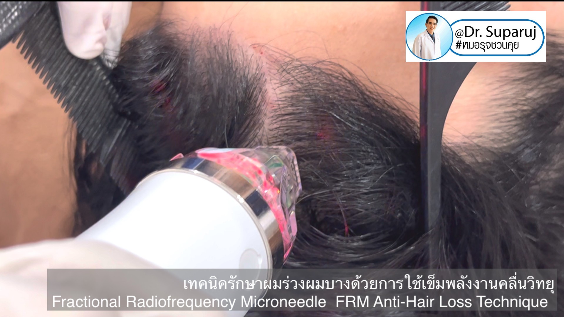 แนะนำเทคนิครักษาผมร่วงผมบาง: เทคนิครักษาผมร่วงผมบางด้วยการใช้เข็มพลังงานคลื่นวิทยุ Fractional Radiofrequency Microneedle FRM Anti-Hair Loss Technique แนะนำเทคนิครักษาผมร่วงผมบาง: เทคนิครักษาผมร่วงผมบางด้วยการใช้เข็มพลังงานคลื่นวิทยุ Fractional Radiofrequency Microneedle FRM Anti-Hair Loss Technique