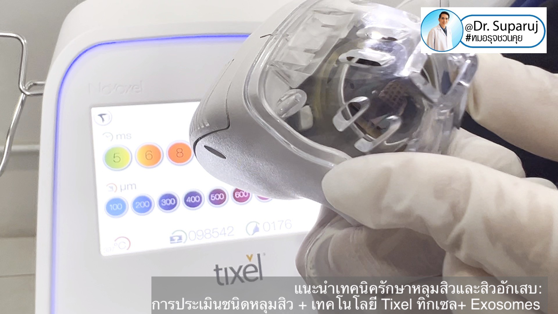 แนะนำเทคนิครักษาหลุมสิวและสิวอักเสบ: ประเมินชนิดความรุนแรงหลุมสิว + เทคโนโลยี Tixel ทิกเซล+ Exosomes แนะนำเทคนิครักษาหลุมสิวและสิวอักเสบ: ประเมินชนิดความรุนแรงหลุมสิว + เทคโนโลยี Tixel ทิกเซล+ Exosomes