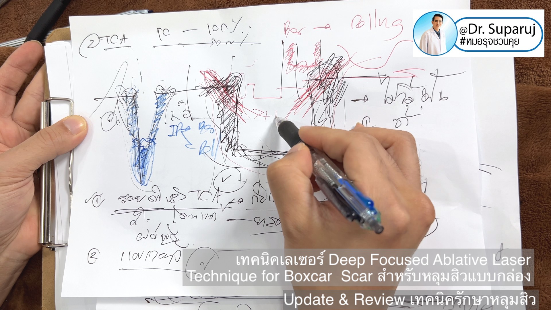 Update & Review เทคนิครักษาหลุมสิว (Acne Scar Treatment: Update & Review) Update & Review เทคนิครักษาหลุมสิว (Acne Scar Treatment: Update & Review)