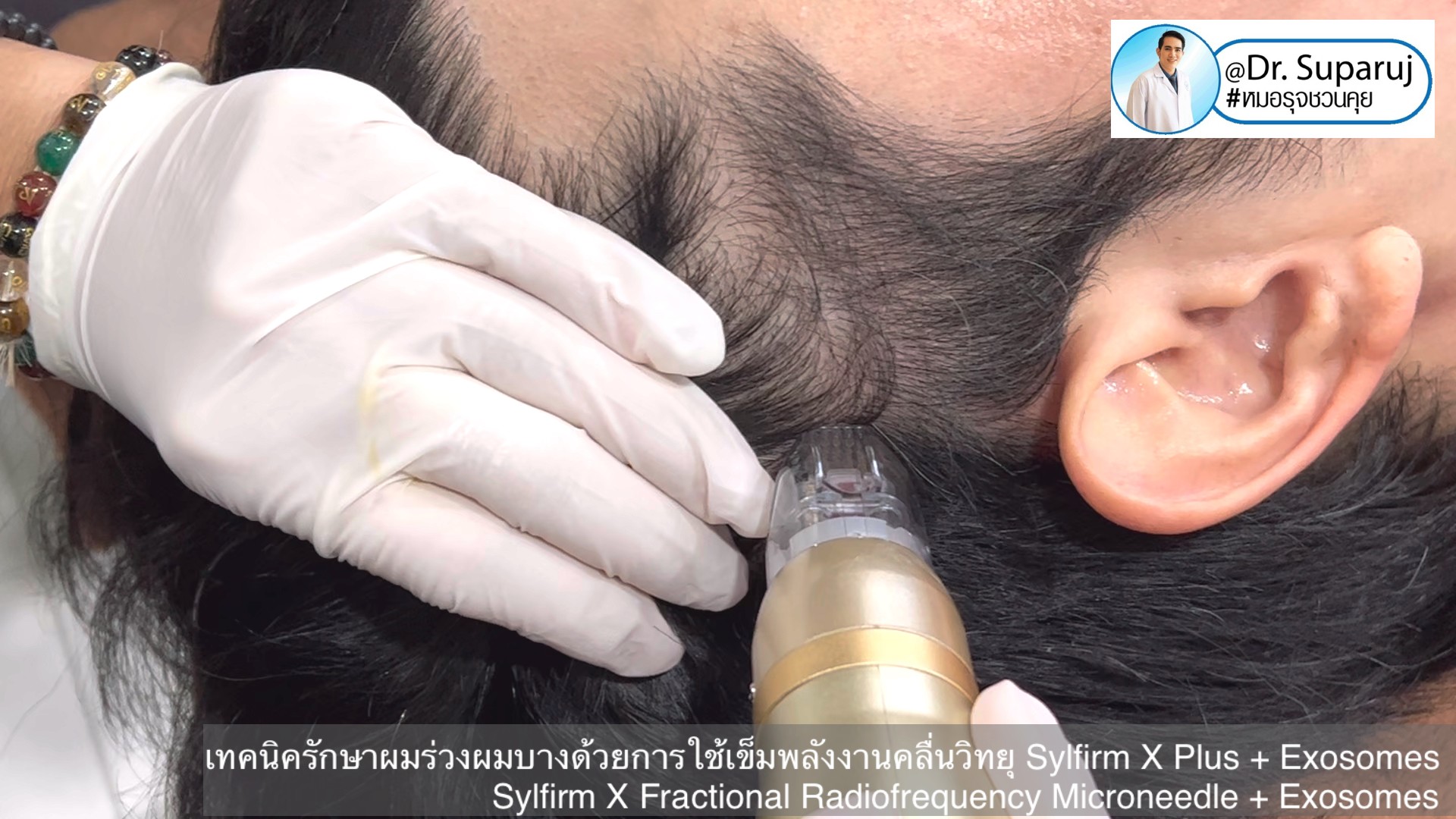 แนะนำเทคนิคดูแลผมร่วงผมบางด้วย Sylfirm X Fractional RF Microneedle + Exosomes for Hair Loss Treatment แนะนำเทคนิคดูแลผมร่วงผมบางด้วย Sylfirm X Fractional RF Microneedle + Exosomes for Hair Loss Treatment