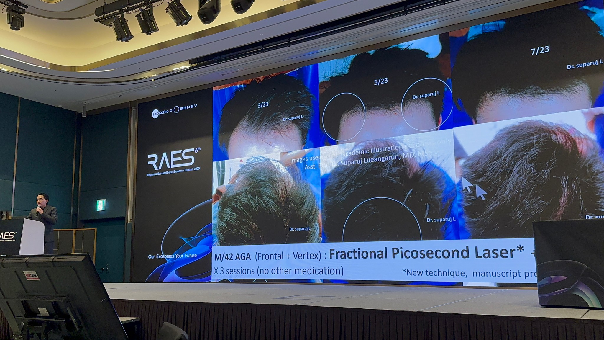 ผู้ช่วยศาสตราจารย์ นายแพทย์ ศุภะรุจ เลื่องอรุณ (หมอรุจ) ได้รับเกียรติร่วมบรรยาย Clinical Aplication of Exosomes และได้รับรางวัล CLINICAL CASE Award ผู้ช่วยศาสตราจารย์ นายแพทย์ ศุภะรุจ เลื่องอรุณ (หมอรุจ) ได้รับเกียรติร่วมบรรยาย Clinical Aplication of Exosomes และได้รับรางวัล CLINICAL CASE Award