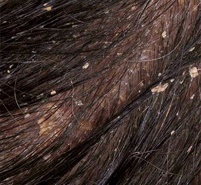 แนะนำเทคนิคการใช้แชมพู ดูแลหนังศีรษะอักเสบ รังแค เซ็บเดิร์ม สะเก็ดเงิน แนะนำเทคนิคการใช้แชมพู ดูแลหนังศีรษะอักเสบ รังแค เซ็บเดิร์ม สะเก็ดเงิน