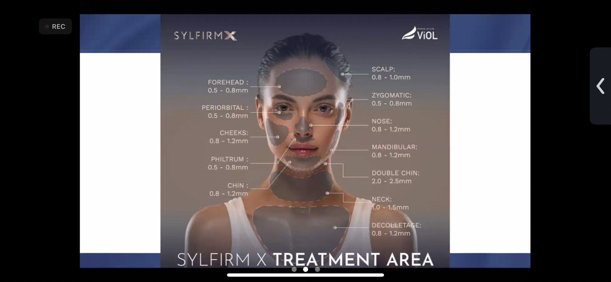 แนะนำเทคนิคดูแลฝ้า ด้วย SYLFIRM X Plus (SYLFIRMX Plus Fractional Radiofrequency Microneedle to Treat Melasma)