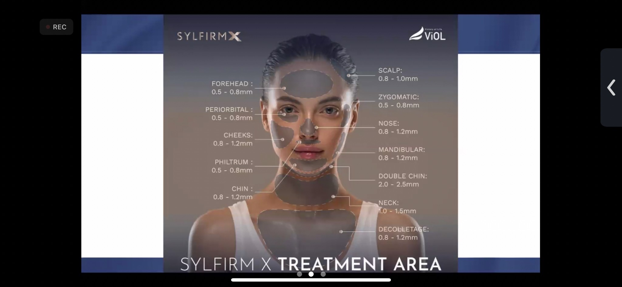 แนะนำเทคนิคดูแลฝ้า ด้วย SYLFIRM X Plus (SYLFIRMX Plus Fractional Radiofrequency Microneedle to Treat Melasma) แนะนำเทคนิคดูแลฝ้า ด้วย SYLFIRM X Plus (SYLFIRMX Plus Fractional Radiofrequency Microneedle to Treat Melasma)
