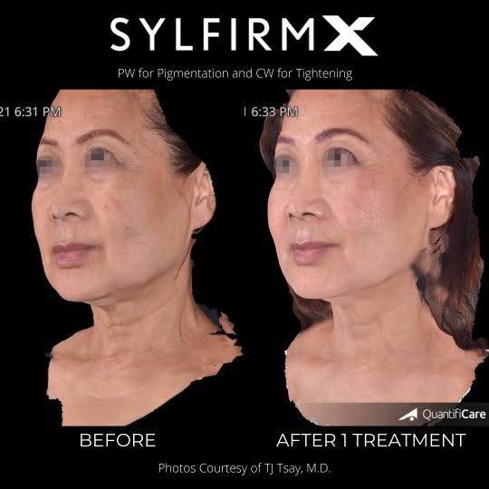 แนะนำเทคนิคดูแลฝ้า ด้วย SYLFIRM X Plus (SYLFIRMX Plus Fractional Radiofrequency Microneedle to Treat Melasma) แนะนำเทคนิคดูแลฝ้า ด้วย SYLFIRM X Plus (SYLFIRMX Plus Fractional Radiofrequency Microneedle to Treat Melasma)