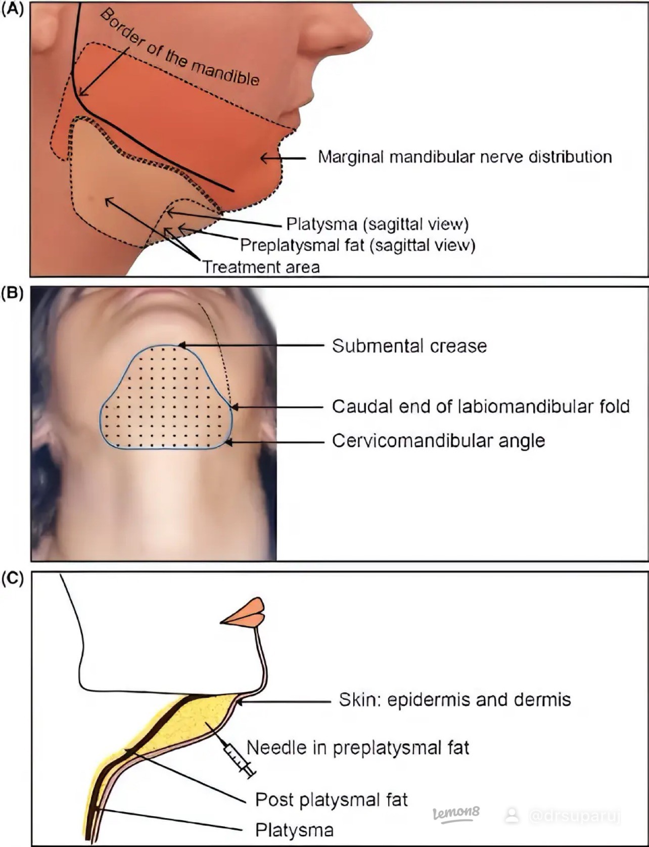 สาเหตุ & เทคนิคลดเหนียง ไขมันใต้คาง คาง 2 ชั้น Double Chin & Submental Fullness Treatment 