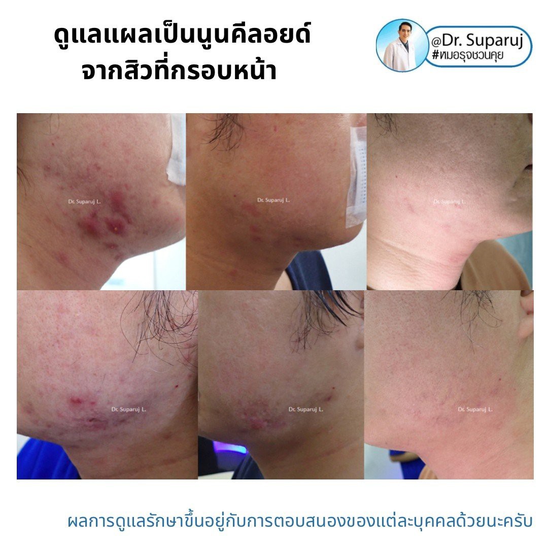 แนะนำเทคนิคดูแลแผลเป็นนูนคีลอยด์: รักษาแผลเป็นนูนคีลอยด์จากสิวที่กรอบหน้าด้วยเทคนิค Discovery Picosecond Laser + Fractional Ablative Laser + LADD Laser-Assisted Drug Delivery แนะนำเทคนิคดูแลแผลเป็นนูนคีลอยด์: รักษาแผลเป็นนูนคีลอยด์จากสิวที่กรอบหน้าด้วยเทคนิค Discovery Picosecond Laser + Fractional Ablative Laser + LADD Laser-Assisted Drug Delivery