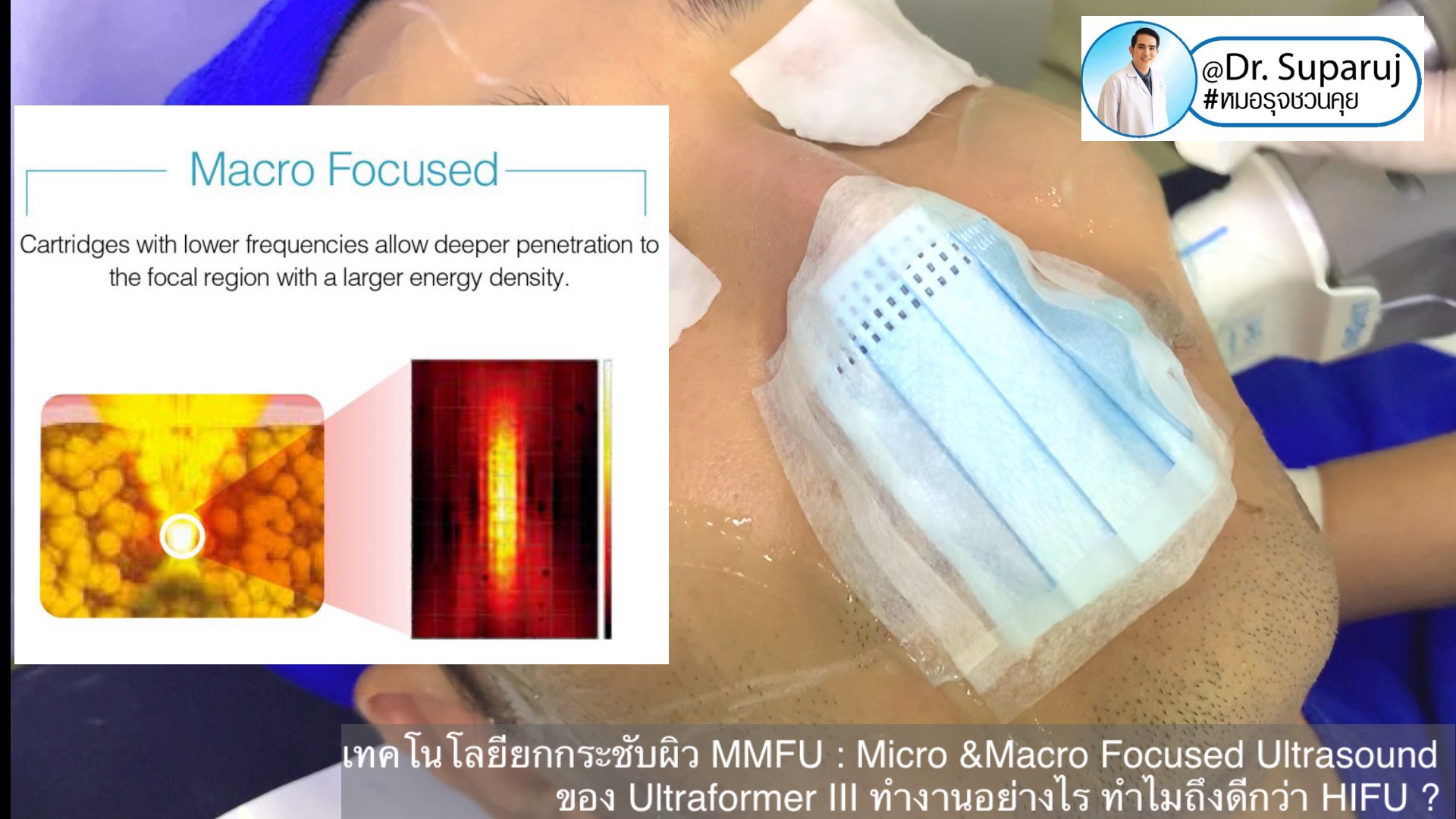 เทคโนโลยียกกระชับผิว MMFU : Micro &Macro Focused Ultrasound ของ Ultraformer III ทำงานอย่างไร ทำไมถึงดีกว่า HIFU ? เทคโนโลยียกกระชับผิว MMFU : Micro &Macro Focused Ultrasound ของ Ultraformer III ทำงานอย่างไร ทำไมถึงดีกว่า HIFU ?