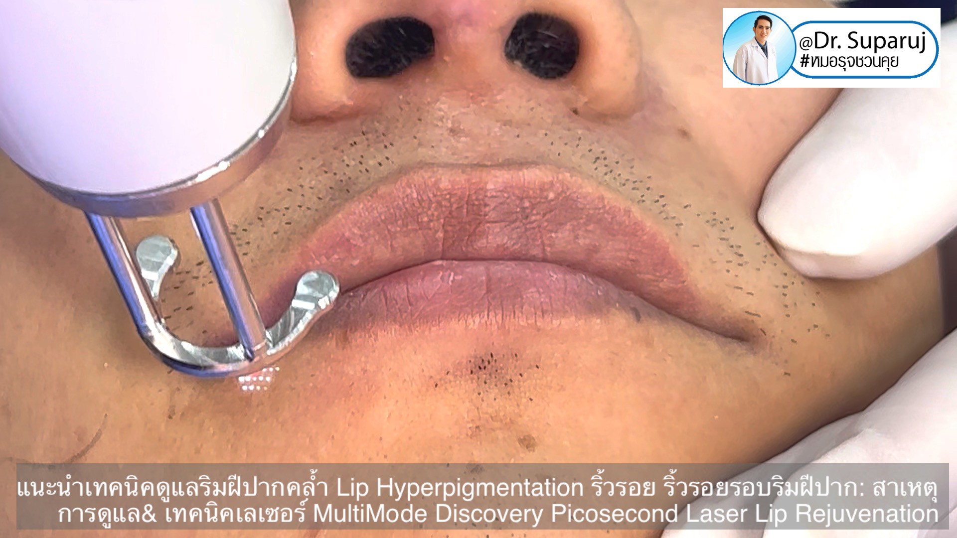 แนะนำเทคนิคดูแลริมฝีปากคล้ำ Lip Hyperpigmentation ริ้วรอย ริ้วรอยรอบริมฝีปาก: สาเหตุ การดูแล & เทคนิคเลเซอร์ MultiMode Discovery Picosecond Laser Lip Rejuvenation แนะนำเทคนิคดูแลริมฝีปากคล้ำ Lip Hyperpigmentation ริ้วรอย ริ้วรอยรอบริมฝีปาก: สาเหตุ การดูแล & เทคนิคเลเซอร์ MultiMode Discovery Picosecond Laser Lip Rejuvenation