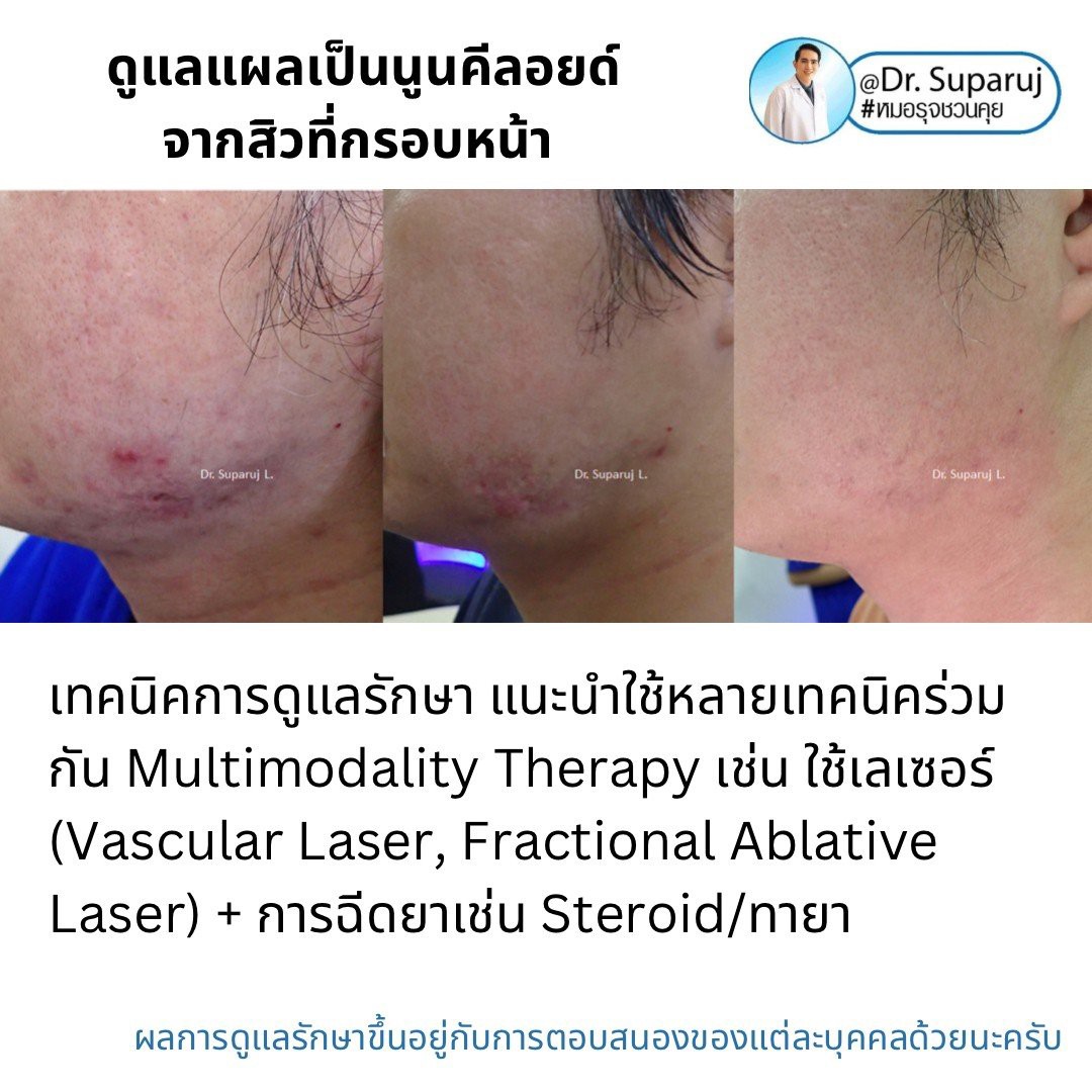 แนะนำเทคนิคดูแลแผลเป็นนูนคีลอยด์: รักษาแผลเป็นนูนคีลอยด์จากสิวที่กรอบหน้าด้วยเทคนิค Discovery Picosecond Laser + Fractional Ablative Laser + LADD Laser-Assisted Drug Delivery แนะนำเทคนิคดูแลแผลเป็นนูนคีลอยด์: รักษาแผลเป็นนูนคีลอยด์จากสิวที่กรอบหน้าด้วยเทคนิค Discovery Picosecond Laser + Fractional Ablative Laser + LADD Laser-Assisted Drug Delivery