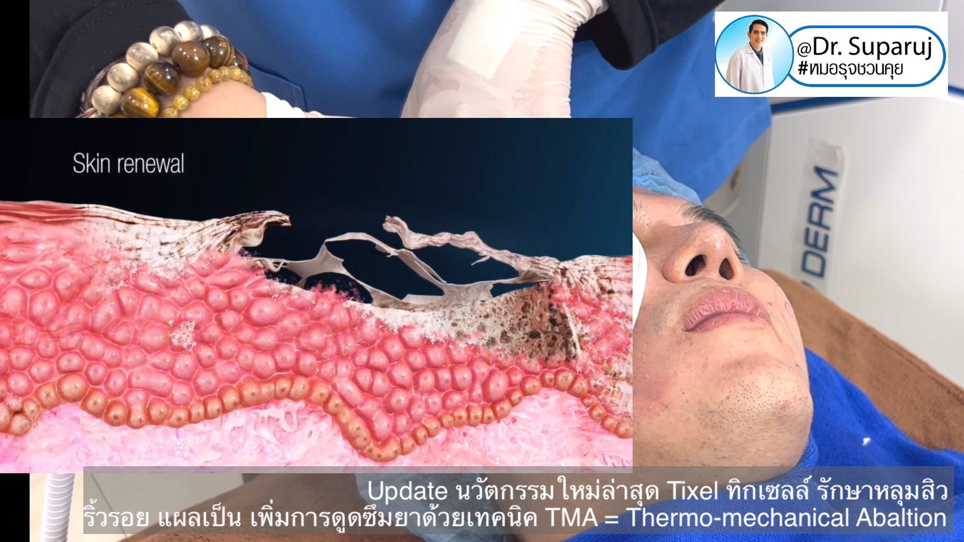 Update นวัตกรรมใหม่ล่าสุด Tixel ทิ๊กเซลล์ รักษาหลุมสิว ริ้วรอย แผลเป็น + Periorbital Tixel Treatment ดูแลริ้วรอยเปลือกตาและรอบดวงตาด้วยเทคนิค TMA = Thermo-mechanical Abaltion Update นวัตกรรมใหม่ล่าสุด Tixel ทิ๊กเซลล์ รักษาหลุมสิว ริ้วรอย แผลเป็น + Periorbital Tixel Treatment ดูแลริ้วรอยเปลือกตาและรอบดวงตาด้วยเทคนิค TMA = Thermo-mechanical Abaltion