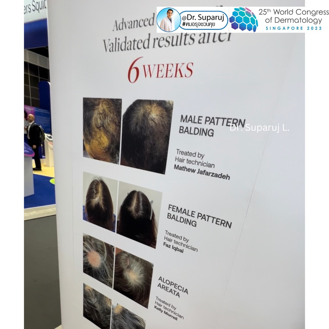 Update จากการประชุมแพทย์ผิวหนังระดับโลก WCD 2023: นวัตกรรมในการดูแลผมร่วงผมบางด้วยการใช้ Calecim Advanced Hair System Update จากการประชุมแพทย์ผิวหนังระดับโลก WCD 2023: นวัตกรรมในการดูแลผมร่วงผมบางด้วยการใช้ Calecim Advanced Hair System